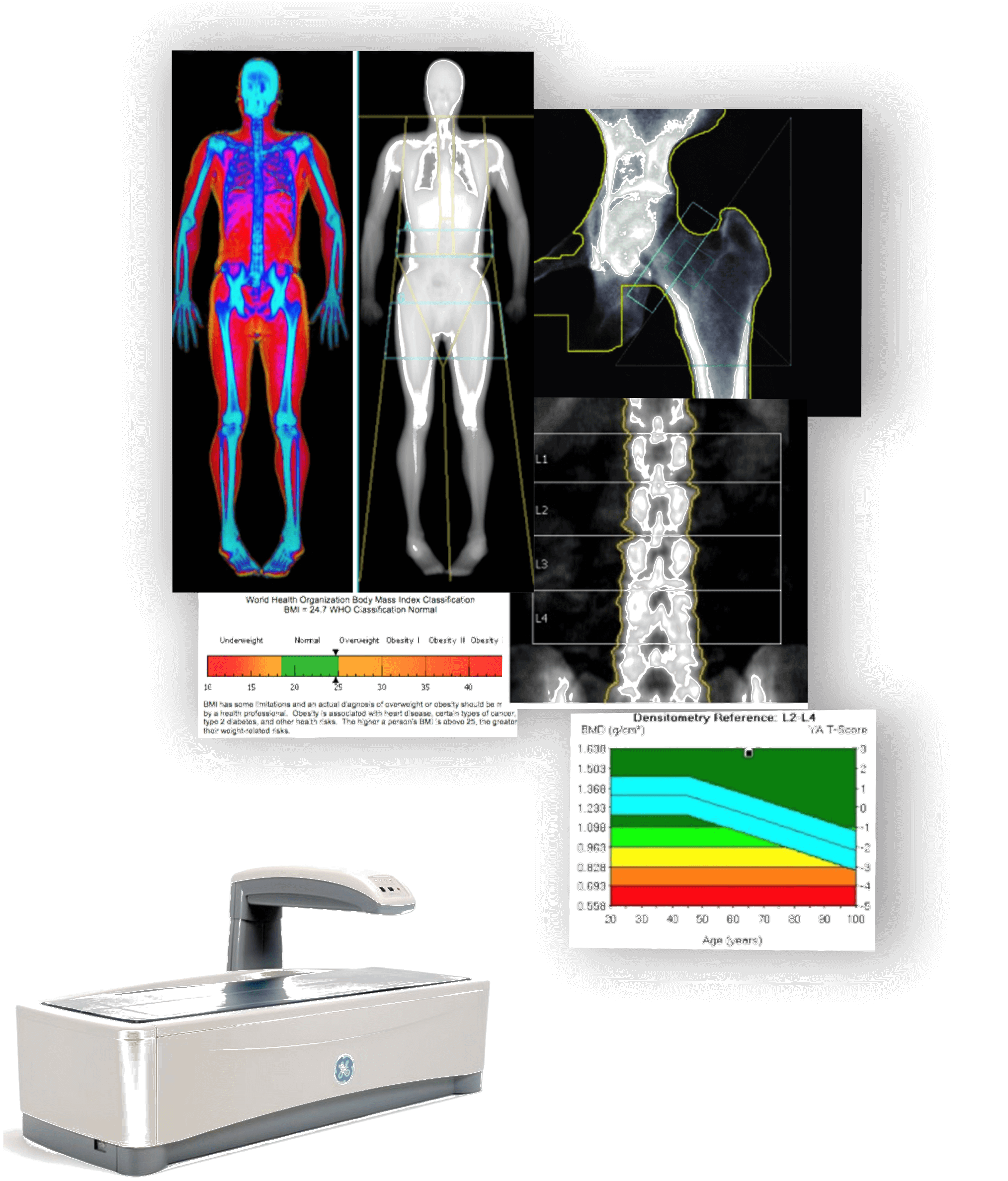 Mosaico de Densitometria