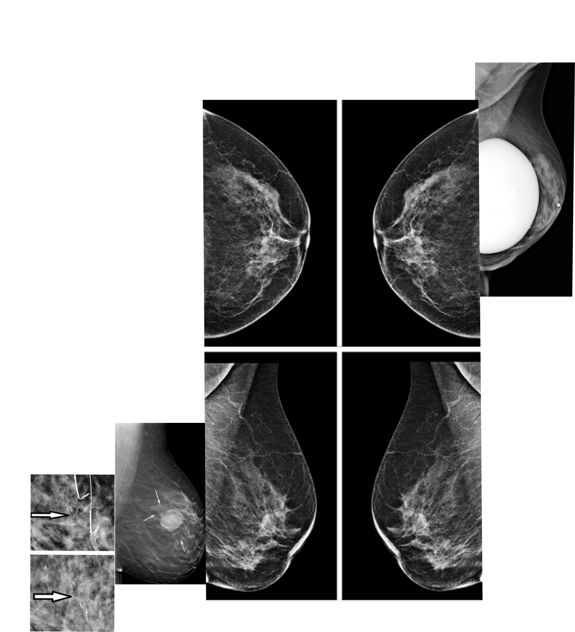 Mosaico de Mamografia