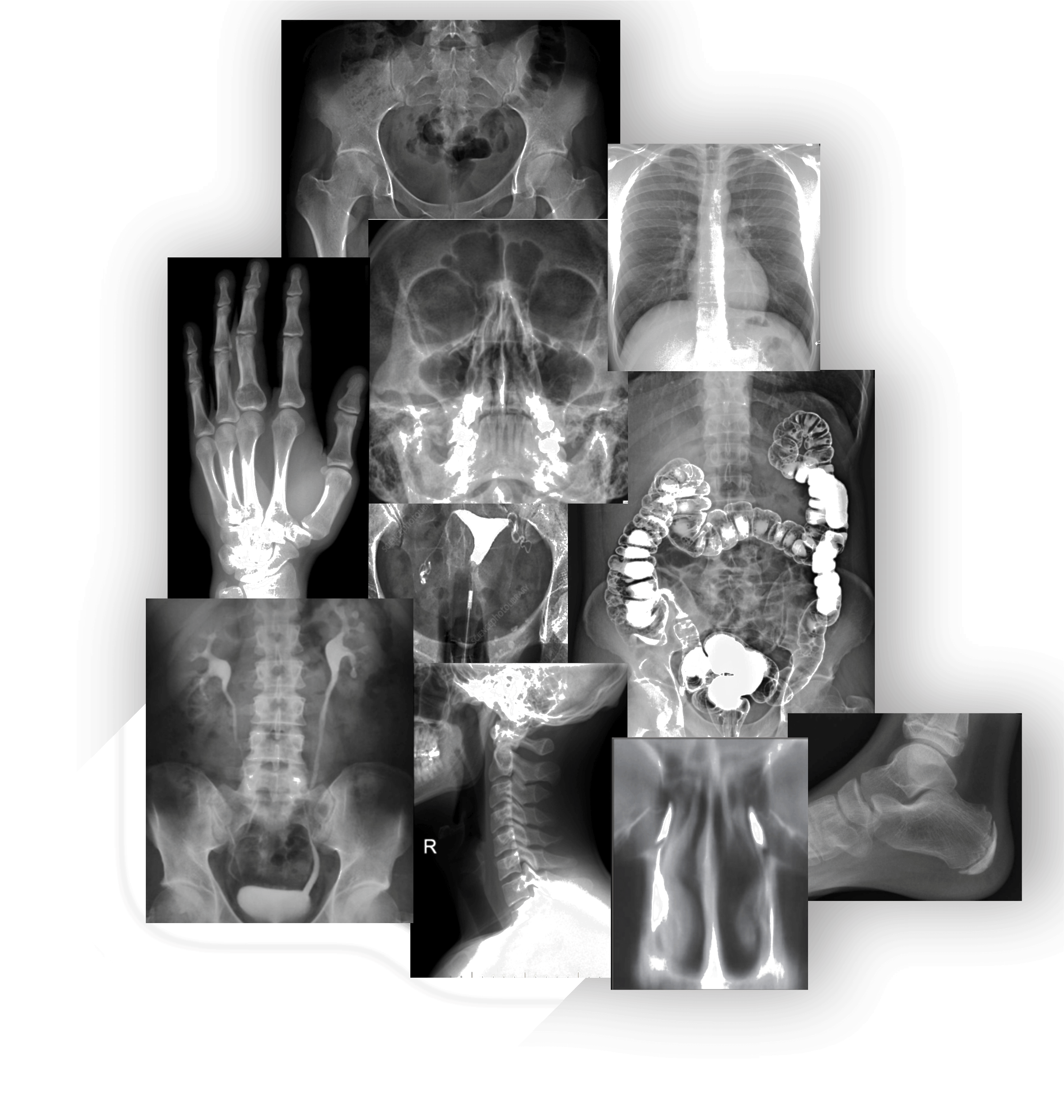 Mosaico de Radiografia Digital