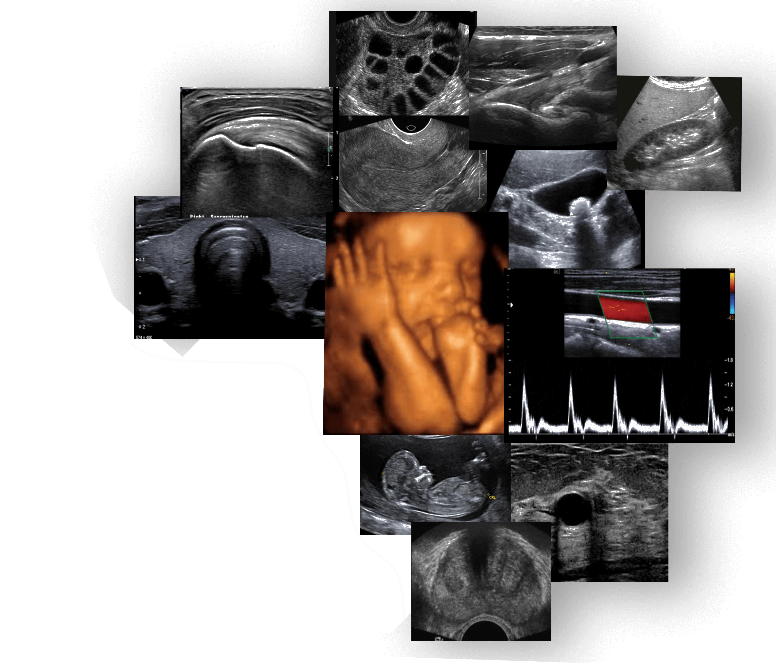Mosaico de Ultrassonografia